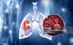 Tuberculosis