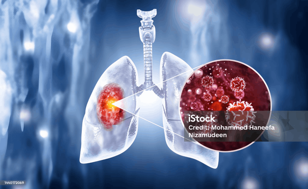 Damage Chest by Tubercular cist left side indicate tuberculosis